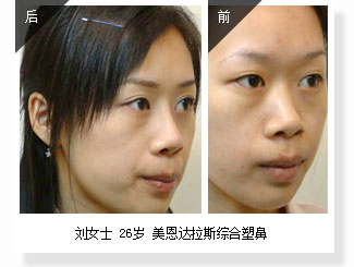 刘女士 26岁 美恩达拉斯综合塑鼻