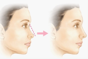 做注射隆鼻去哪里相对好呢